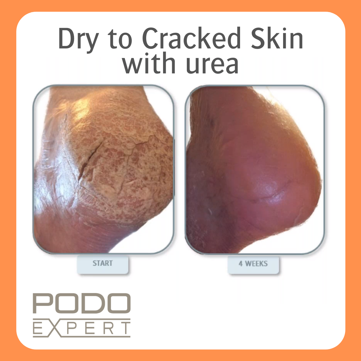 PODOEXPERT DRY TO CRACKED SKIN FOAM - PRO SIZE