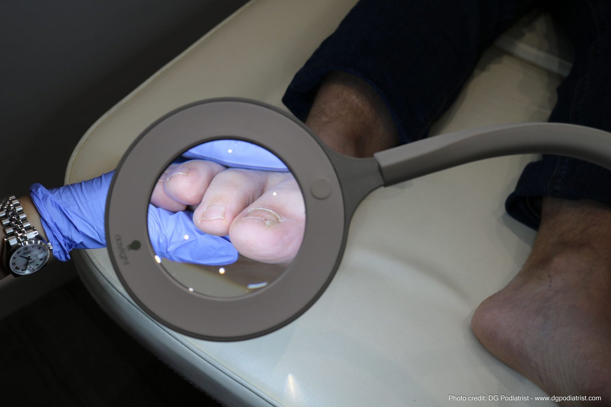 Magnified Toenail with Omega 3.5 Magnifier Light